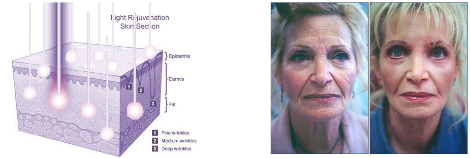 Skin Rejuvenation