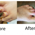 Laser Therapy