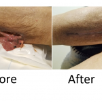 Laser Therapy